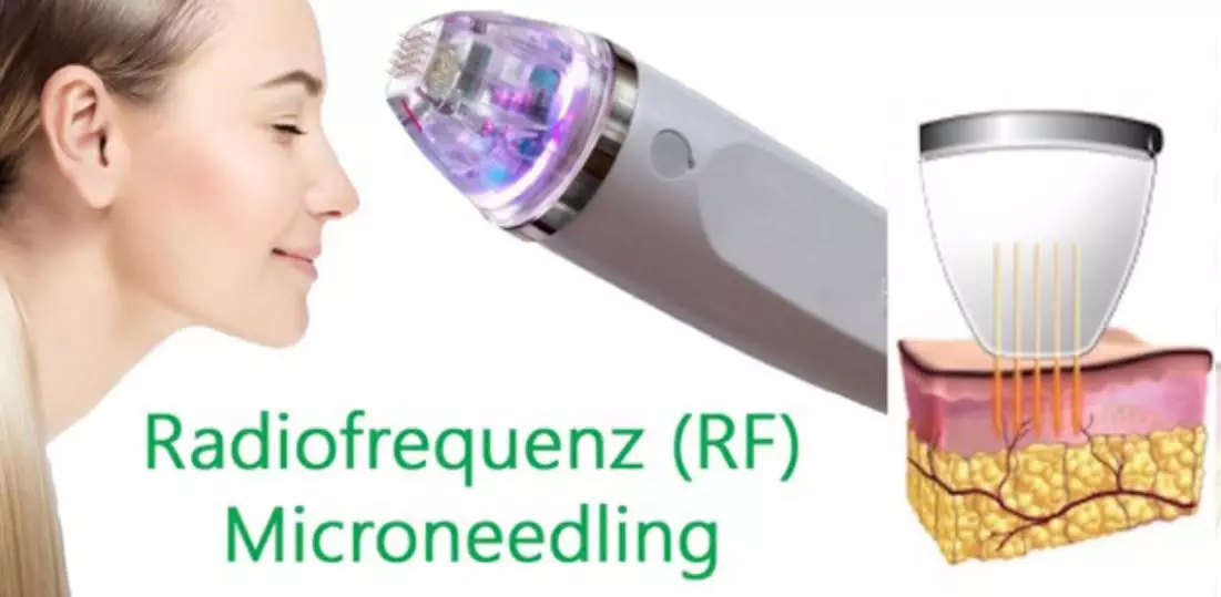 radiofrequenz microneedling